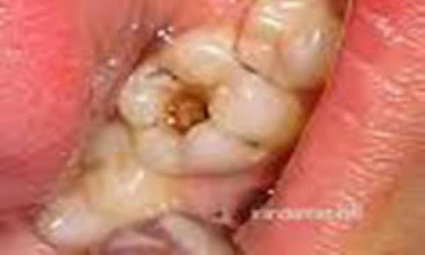 دلیل دندان قروچه